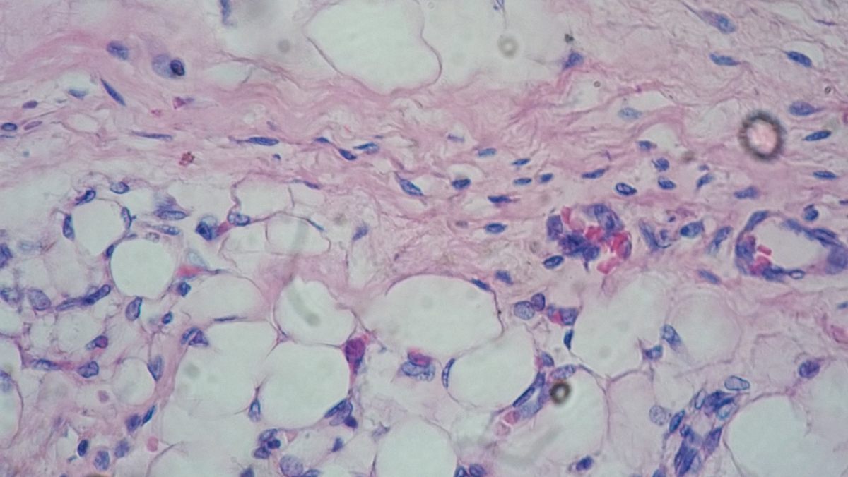 Unos investigadores descubren una población de células en el tejido adiposo omental humano que podría tener un papel crucial en la lucha contra la obesidad