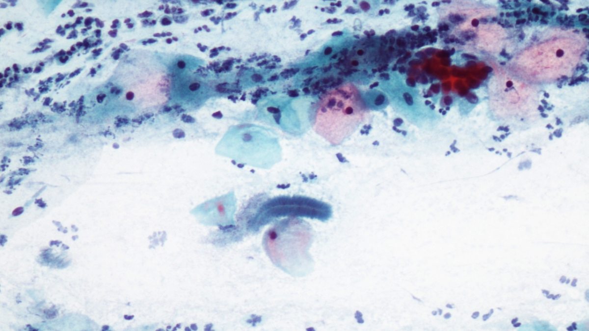 Un nuevo estudio señala que las pruebas de VPH a intervalos más largos pueden ser igualmente seguras para la detección del precáncer cervical