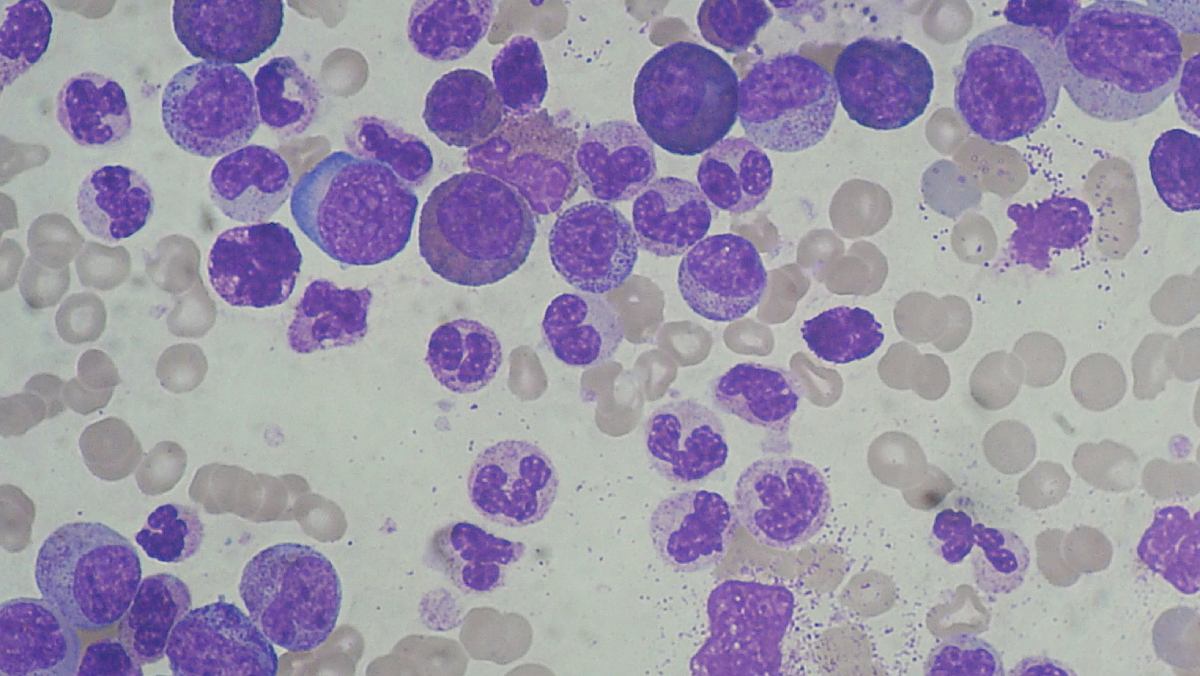 El Instituto del Cáncer Dana-Farber presenta un nuevo avance terapéutico para combatir ciertos tipos de leucemia