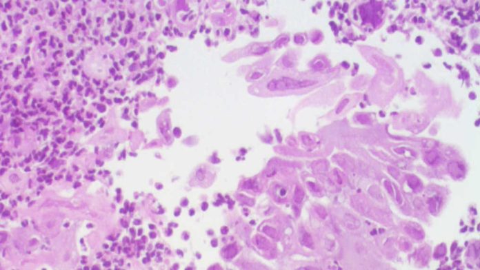 Virus del herpes