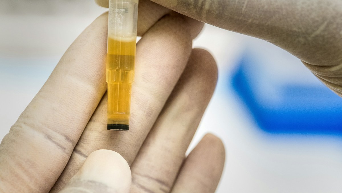Investigadores de la Universidad de Michigan desarrollan un test de orina que revoluciona la detección del cáncer de próstata