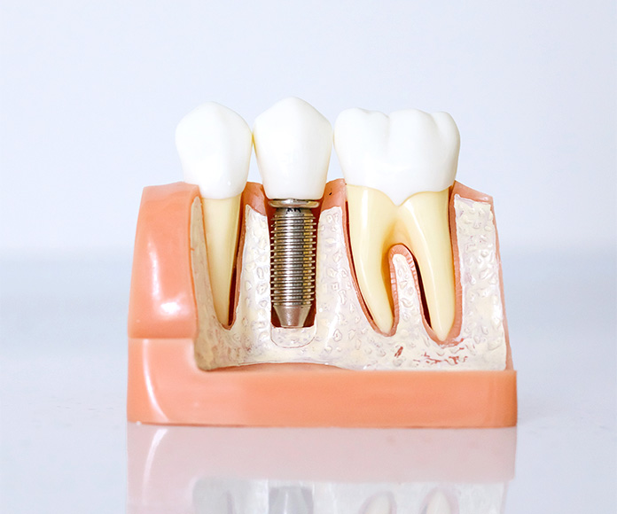 Modelo dental con implante dental