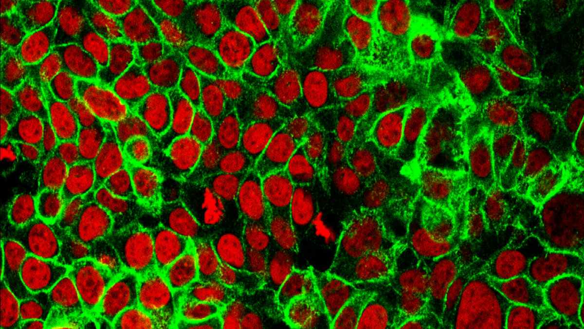 Unos investigadores identifican un gen clave en la progresión y tratamiento del cáncer de pulmón
