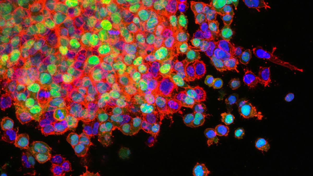 Un grupo de especialistas asegura que solo el 25% de los casos de cáncer de ovario se detecta en etapas iniciales