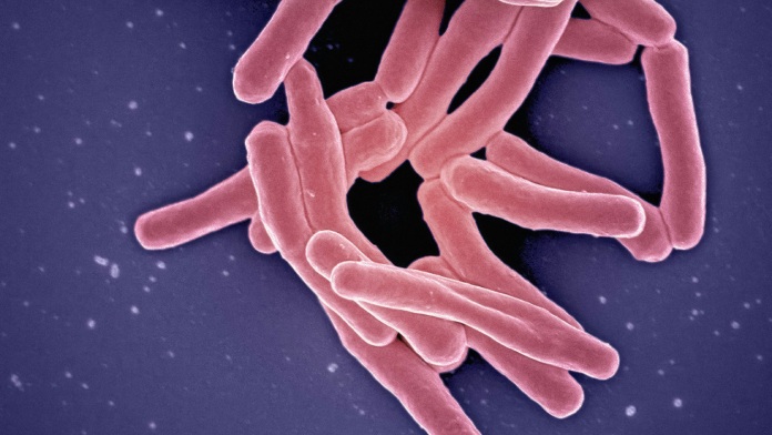 Tuberculosis